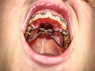 牙齿上有牙套的青少年 牙套长了一大副牙套男生乳牙煤球下巴童年牙科咀嚼孩子口服牙医图片
