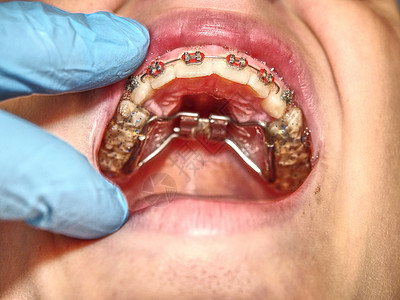 检查或治疗期间有牙牙牙套的病人诊断药品注射器医院高架手套乐器专家办公室牙齿图片