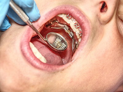 检查Hyrax卫生快速扩张器牙龈健康保险矫正牙科诊所考试金属乳牙手术牙齿图片