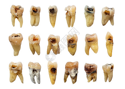 一组牙齿牙齿(牙齿腐烂) 氟化物和微积分 孤立的背景图片