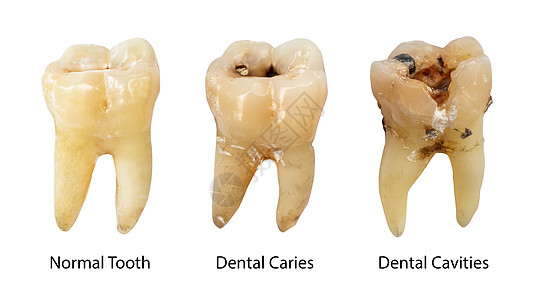 正常牙齿 龋齿和有结石的牙腔 不同蛀牙阶段的比较 白色孤立的背景 正面视图图片