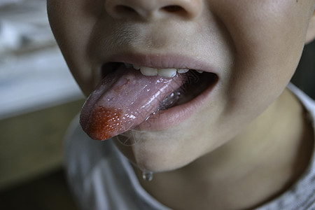 亲近嘴唇 舌头 血流成河 孩子被咬的舌头男生感染溃疡痛苦牙齿疼痛水疱治疗卫生疾病图片