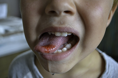 亲近嘴唇 舌头 血流成河 孩子被咬的舌头卫生水疱男生疼痛疾病治疗溃疡感染宏观痛苦图片