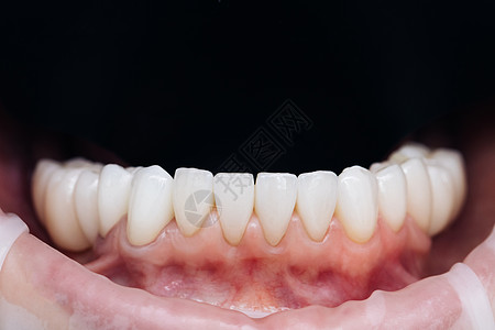固定后的贴面 自然色 美容牙科贴面 牙科诊所的现代牙科设备和贴面安装程序图片