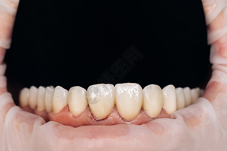 与锆人造牙的特写照片 锆冠 牙科保健 最终版本的陶瓷锆 染色和上光 精密设计和优质材料图片