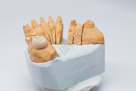 免费金属陶瓷牙 完全白色背景的石膏模型上的陶瓷牙齿 带有贴面的陶瓷牙齿图片