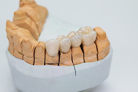 白底孤立的石膏模型上的金属陶瓷桥 克朗阳性体 用显形器制成的陶瓷牙齿图片