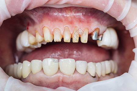 特写牙科病人在牙医办公室 母牙大锆 与锆人造牙的特写照片 氧化锆瓷桥图片