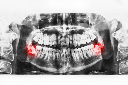 口腔口腔X光图像 白背景的智慧牙齿越来越低电影药品考试解剖学男人病人射线卫生骨骼辐射图片