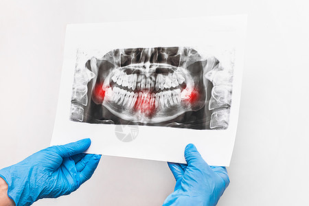 医生戴着防护性医用手套的手拿着并检查白色背景下牙齿的 X 光照片辐射疼痛诊所骨骼男人照相手术牙疼口服射线图片