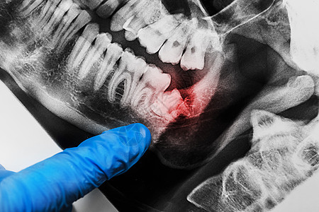 一位医生的手戴着防护性医用手套 手指指向下颌智齿的生长 在口腔的 X 射线图像上 特写扫描男人解剖学电影病人牙科药品骨骼医院考试图片