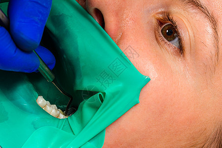 对咀嚼牙齿的治疗 牙医设置了橡胶大坝 使用消毒工具 使用现代技术病人牙科空腔馅料临床橡皮障方法眼镜保健过程图片