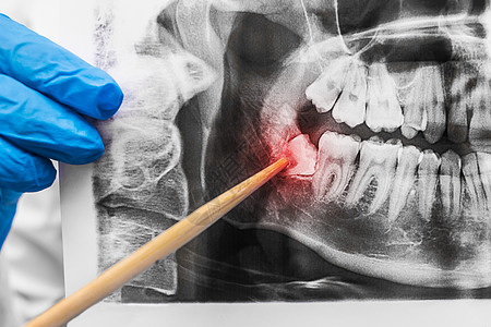 牙医手放在医用橡皮手套里 对口部的X光图像进行X光检查 并指向精制的智牙 特写图片
