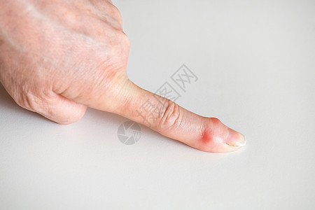老年男子用白种手指着生病的女性手指的白色背景压力医生风湿症状药品伤害疾病疼痛成人痛苦图片