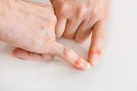 一名老年妇女的两只手表示手指有病 关节情况有所改变接缝情况风湿痛苦女性病人诊所诊断女士畸形疾病症状图片