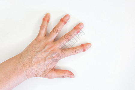 一只老女人的手 在白种背景上手指痛状况疾病风湿女性药品卫生痛苦伤害成人女士图片