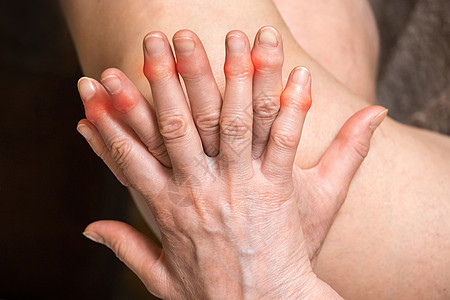 年长妇女的手有伤痛的手指 手指处理概念皮肤压力畸形伤害卫生手臂疼痛老年成人状况图片
