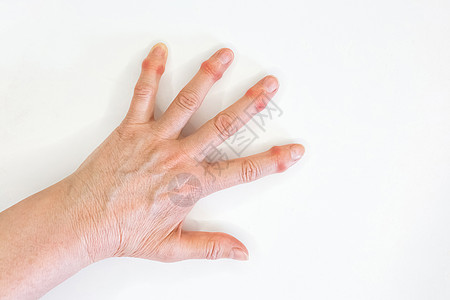 一只老女人的手 在白种背景上手指痛皮肤老年医生病人疾病女性女士伤害症状卫生图片