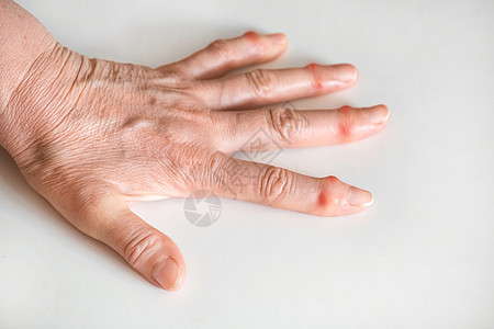 白种背景的老年老手生病的女性手指畸形症状成人手臂卫生疼痛状况医生伤害压力背景图片
