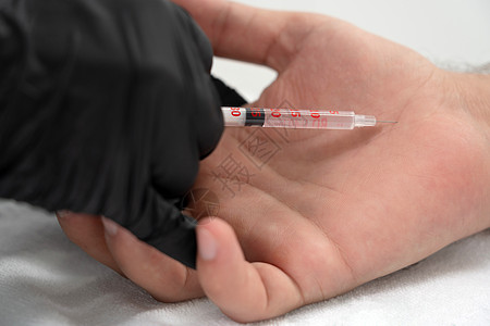 医生用一剂肉毒杆菌毒素在男性手掌手中注射 防止过多出汗 治疗过激中毒肌肉香味护理病人注射器腋窝沙龙肉毒男人身体图片