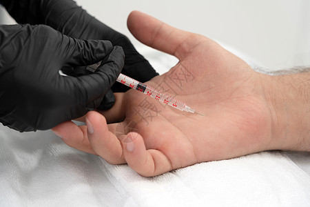 医生用一剂肉毒杆菌毒素在男性手掌手中注射 防止过多出汗 治疗过激中毒汗腺身体药品气味肉毒美容师男人香味皮肤病人图片