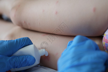 医生在诊所检查儿童腿部红皮疹并施用催膜卫生症状童年状况护士诊断疙瘩保险疾病调查图片