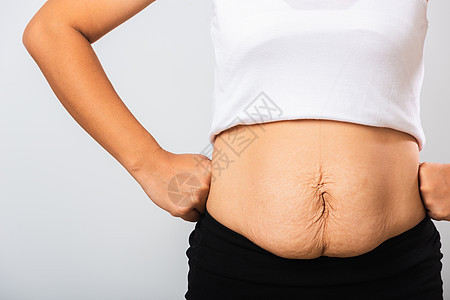 孕期婴儿出生后脂肪的低腹部皮肤松动 产卵后发胖邮政母亲瘢痕肚子妈妈怀孕药品女孩重量条纹图片
