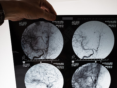 脑部核磁共振成像扫描图像 手握一张照片药品卫生病人x光疾病医院科学保健颅骨x射线图片