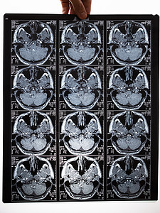 脑部核磁共振成像扫描图像 手握一张照片辐射医院癌症卫生医生科学技术治疗实验室病人图片