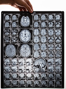 脑部核磁共振成像扫描图像 手握一张照片医生科学创伤解剖学治疗x光断层技术药品射线图片