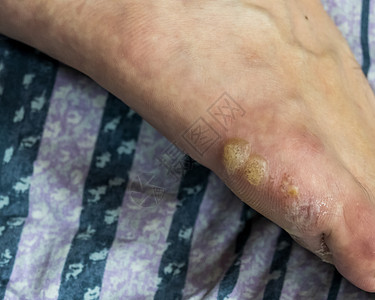 徒步多泡水器医疗细菌伤口伤害真菌卫生湿疹脚趾感染水疱图片