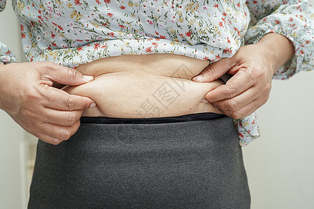 超重的亚裔女性用手挤压胖肚子 大体积超重和肥胖症治疗腹部烧伤健康展示肌肉肥胖组织成人锻炼图片