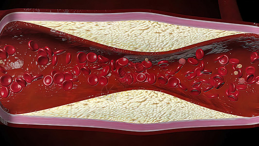 由胆固醇血液或容器内引发冠心动动脉病的板块导致的胆固醇血或红细胞流动梗阻动脉硬化牌匾形成镜头毛细管主动脉心脏病学背景图片