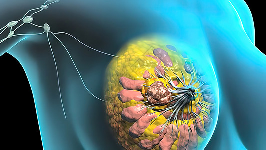 具有乳腺病理学的  女孩  女性人的结构说明和缝合宏观化疗癌症科学硬化细胞淋巴瘤医生生物解剖学图片