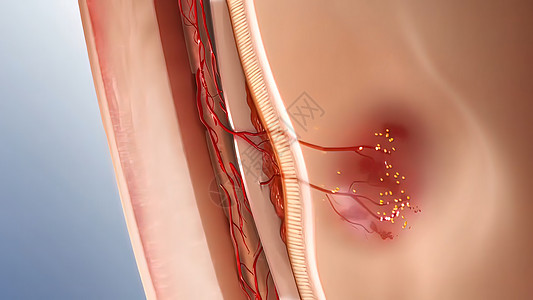 Glaucoma眼病 3D例感染病菌冰雹链球菌眼科化妆品疾病卫生睫毛细菌图片