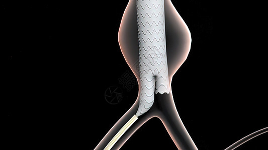 3D 脉搏剖腹膜动脉瘤医学插图消化糖病糖尿病呼吸肋骨生理粗肠杯子器官事故图片
