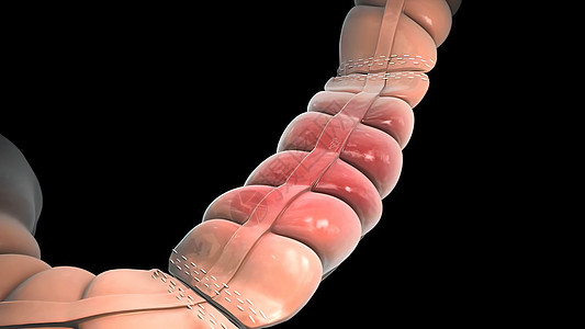 切除肠道任何部分的外科手术 肠内分解便秘诊断眼镜指法生长解剖学检查卫生粘膜病变图片