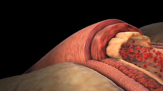 正常血压3d疾病诊所动脉粥样硬化管道静脉梗塞动脉血管流动手术图片