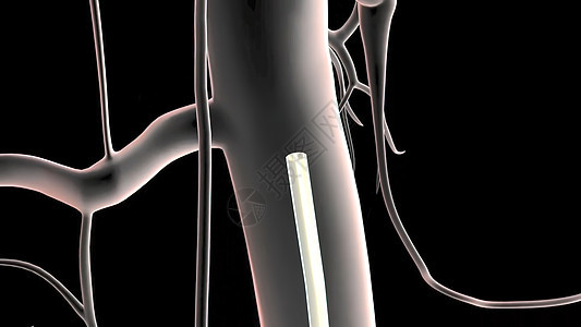 腹膜动脉动脉瘤治疗手术刀插图病人腹部服务手套作品动脉外科器官图片