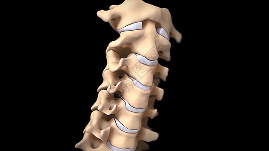 有神经根的人类脊椎压力绳索骨骼姿势运河疼痛柱子外科脊柱治疗图片