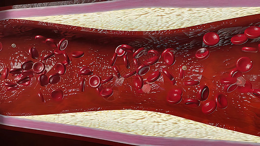 由胆固醇血液或容器内引发冠心动动脉病的板块导致的胆固醇血或动脉牌匾心脏病学水果流动管道渲染镜头主动脉食物图片