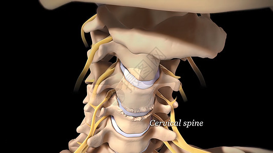 脊椎膜切除是脊椎骨间缓冲和连接组织受伤的伤痕骨科光盘柱子外科骨干骨骼诊断药品创伤插图图片
