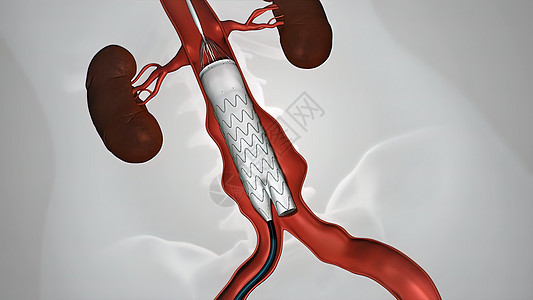 静脉有螺纹的气球血管成形程序动脉金属心血管中风牌匾心脏病学导管治疗主动脉管道图片