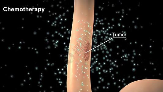 化疗应用在肿瘤地区 肿瘤被清理干净了医学癌症卫生甲状腺胸部微生物学身体前列腺疾病保健图片