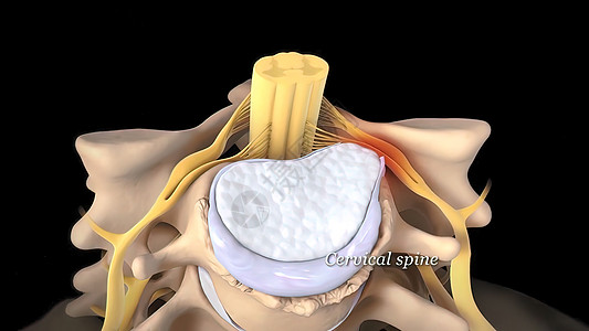 脊椎膜切除是脊椎骨间缓冲和连接组织受伤的伤痕椎骨疗法整脊骨头疾病骶椎骨骼腕管症状柱子图片
