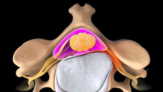 由于滑动盘片造成的神经紧张压力外科疾病髓质椎间症状骨头手指疗法光盘整脊图片