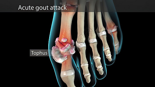 关节炎是一种关节炎 突然 剧烈的疼痛外翻症状脚趾痛风肌腱药品骨骼男性疾病风湿病图片