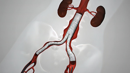 静脉有螺纹的气球血管成形程序夹子血小板导管外科渲染牌匾支架干涉手术管道图片