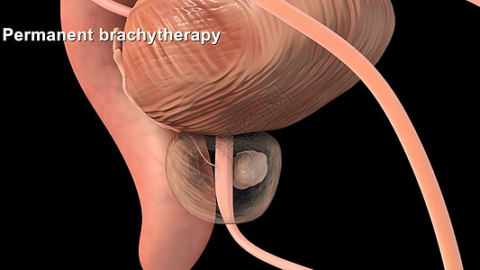 医学精确的3d 前列腺癌说明肾脏尿道尿液科学艺术品器官前列腺肌肉骨骼生理图片