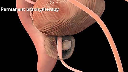 医学精确的3d 前列腺癌说明肾脏尿道尿液科学艺术品器官前列腺肌肉骨骼生理背景图片